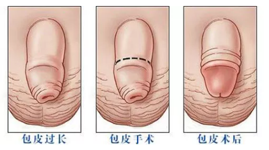 宝鸡宁城县包皮过长原因是什么呢