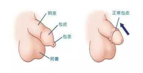 宝鸡林西县包皮包茎的症状有哪些表现