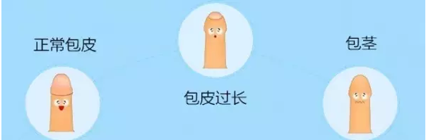 宝鸡克什克腾旗包皮长了会影响什么