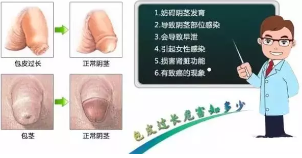 克什克腾旗包皮过长危害大吗?手术有风险吗?